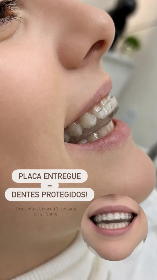 Placa entregue: dentes protegidos do desgaste.