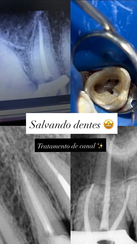 Radiografias e imagem do tratamento de canal.
